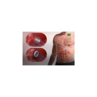 KIT COMPLETO PARA GASTROSTOMÍA ENDOSCÓPICA PERCUTÁNEA
